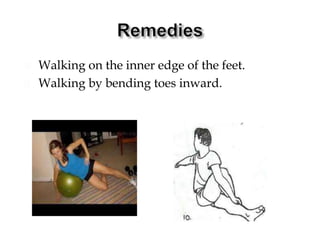  Walking on the inner edge of the feet.
 Walking by bending toes inward.
 