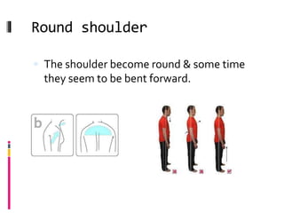 Round shoulder
 The shoulder become round & some time
they seem to be bent forward.
 