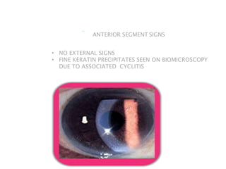 ANTERIOR SEGMENT SIGNS
• NO EXTERNAL SIGNS
• FINE KERATIN PRECIPITATES SEEN ON BIOMICROSCOPY
DUE TO ASSOCIATED CYCLITIS
 