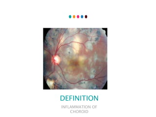CHOROIDITIS
DEFINITION
INFLAMMATION OF
CHOROID
 