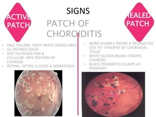 SIGNS
ACTIVE
PATCH PATCH OF
CHOROIDITIS
HEALED
PATCH
• PALE YELLOW/ DIRTY WHITE RAISED AREA
• ILL DEFINED EDGES
• DUE TO EXUDATION &
CELLULAR INFILTRATION OF
CHOROID
• RETINA- OFTEN CLOUDS & ODEMATOUS
• MORE SHARPLY DEFINE & DELINEATED
DUE TO ATROPHY OF CHOROIDAL
TISSUE
• WHITE SCLERA BELOW ATROPIC
CHOROID
• BLACK PIGMENTED CLUMPS AT
PERIPHERY
 