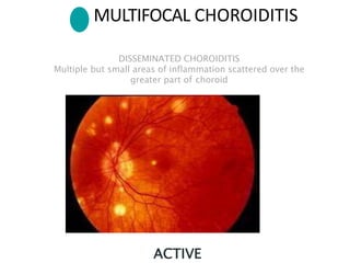 ACTIVE
DISSEMINATED CHOROIDITIS
Multiple but small areas of inflammation scattered over the
greater part of choroid
MULTIFOCAL CHOROIDITIS
 