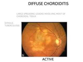 LARGE SPREADING LESIONS INVOLVING MOST OF
CHOROIDAL TISSUE
ACTIVE
SYPHILIS
TUBERCULOSIS
DIFFUSE CHOROIDITIS
 