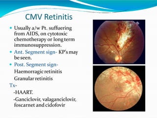 CMV Retinitis
 Usually a/w Pt. suffuering
from AIDS, on cytotoxic
chemotherapy or longterm
immunosuppression.
 Ant. Segment sign- KP’smay
be seen.
 Post. Segment sign-
Haemorragicretinitis
Granularretinitis
Tx-
-HAART.
-Ganciclovir, valaganciclovir,
foscarnet andcidofovir
 