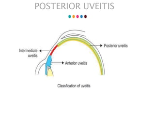 POSTERIOR UVEITIS
 