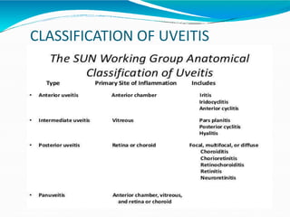 CLASSIFICATION OF UVEITIS
 