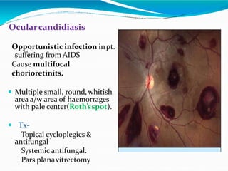 Ocularcandidiasis
Opportunistic infection inpt.
suffering from AIDS
Cause multifocal
chorioretinits.
 Multiple small, round,whitish
area a/w area of haemorrages
with pale center(Roth’sspot).
 Tx-
Topical cycloplegics &
antifungal
Systemic antifungal.
Pars planavitrectomy
 