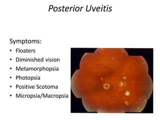 Posterior Uveitis
Symptoms:
• Floaters
• Diminished vision
• Metamorphopsia
• Photopsia
• Positive Scotoma
• Micropsia/Macropsia
 