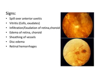 Signs:
• Spill over anterior uveitis
• Vitritis (Cells, exudates)
• Infiltration/Exudation of retina,choroid
• Edema of retina, choroid
• Sheathing of vessels
• Disc edema
• Retinal hemorrhages
 