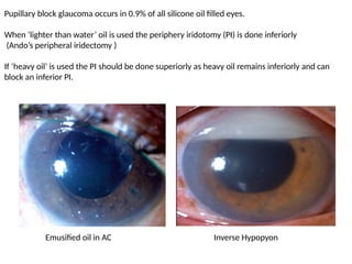 Peripheral Inverse POST VITREORETINAL SURGERY GLAUCOMA.pptx