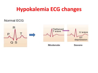 Hypokalemia ECG changes
 