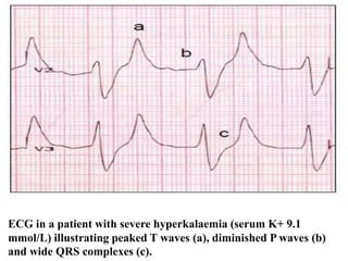 ECG in a patient with severe hyperkalaemia (serum K+ 9.1
mmol/L) illustrating peaked T waves (a), diminished P waves (b)
and wide QRS complexes (c).
 