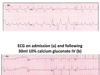 ECG on admission (a) and following
30ml 10% calcium gluconate IV (b)
patient with serum K+ 9.3 mmol/L
 