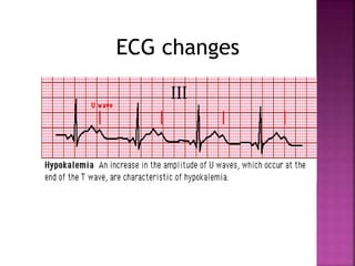 ECG changes
 