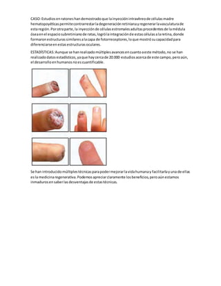 CASO:Estudiosenratoneshandemostradoque lainyecciónintravítreode célulasmadre
hematopoyéticaspermitecontrarrestarladegeneraciónretinianayregenerarlavasculaturade
estaregión.Porotraparte,la inyecciónde célulasestromalesadultasprocedentesde lamédula
óseaenel espaciosubretinianode ratas,logrólaintegraciónde estascélulasalaretina,donde
formaronestructurassimilaresalacapa de fotorreceptores,loque mostrósucapacidadpara
diferenciarseenestasestructurasoculares.
ESTADÍSTICAS:Aunque se hanrealizadomúltiplesavancesencuantoaeste método,no se han
realizadodatosestadísticos,yaque haycercade 20.000 estudiosacercade este campo,peroaún,
el desarrolloenhumanosnoescuantificable.
Se han introducidomúltiplestécnicasparapodermejorarlavidahumanay facilitarlayuna de ellas
esla medicinaregenerativa.Podemosapreciarclaramente losbeneficios,peroaúnestamos
inmadurosensaberlasdesventajasde estastécnicas.
 