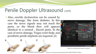  Also, erectile dysfunction can be caused by
nerve damage, like from diabetes. In this
case the nerve signals may not reach the
penis, so the blood flow will appears
identical to a normal , flaccid penis. In the
case of nerve damage, Viagra won’t help, and
prosthetic penile implants are required. (2)
Penile Doppler Ultrasound cont.
http://www.ultrasound-images.com/penis/
http://www.jsm.jsexmed.org/article/S1743-6095(15)34207-7/fulltext121120030 Osamah Alfentokh
 