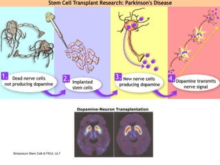 Dopamine-Neuron Transplantation 
