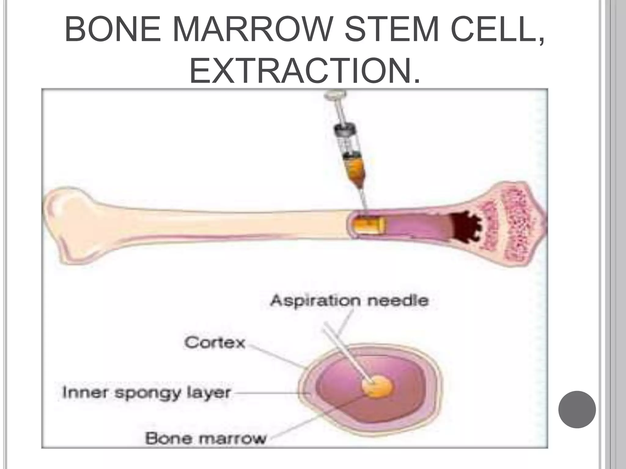 BONE MARROW STEM CELL,
EXTRACTION.
 