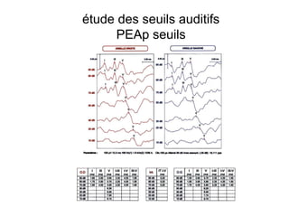 étude des seuils auditifs
PEAp seuils
 