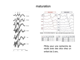 PEAp pour une recherche de
seuils avec des clics chez un
enfant de 2 ans.
maturation
 