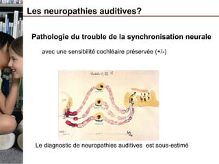 Les neuropathies auditives?
Pathologie du trouble de la synchronisation neurale
avec une sensibilité cochléaire préservée (+/-)
Le diagnostic de neuropathies auditives est sous-estimé
 