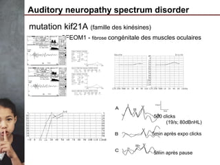 Auditory neuropathy spectrum disorder
mutation kif21A (famille des kinésines)
CFEOM1 - fibrose congénitale des muscles oculaires
500 clicks
(19/s; 80dBnHL)
5min après expo clicks
5min après pause
 