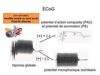 ECoG
réponse globale
potentiel microphonique cochléaire
potentiel d’action composite (PAC)
et potentiel de sommation (PS)
son stimulant:
bouffée tonale ou tone burst
Polarité alternée
(+) + (-)
(+) - (-)
 