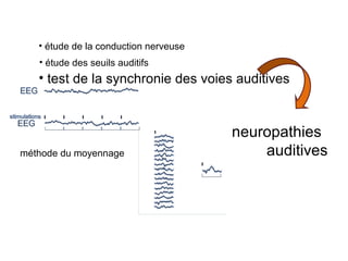 • test de la synchronie des voies auditives
méthode du moyennage
• étude des seuils auditifs
• étude de la conduction nerveuse
neuropathies
auditives
 