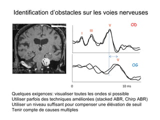0 10 ms
V
I
III
V
OG
OD
Identification d’obstacles sur les voies nerveuses
Quelques exigences: visualiser toutes les ondes si possible
Utiliser parfois des techniques améliorées (stacked ABR, Chirp ABR)
Utiliser un niveau suffisant pour compenser une élévation de seuil
Tenir compte de causes multiples
 