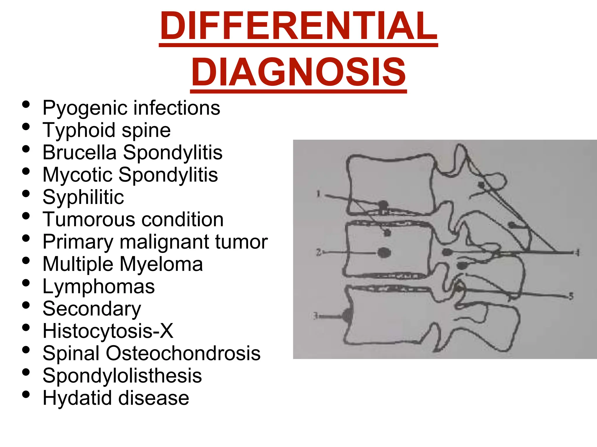 potts disease and its treatment and nursing management .pptx