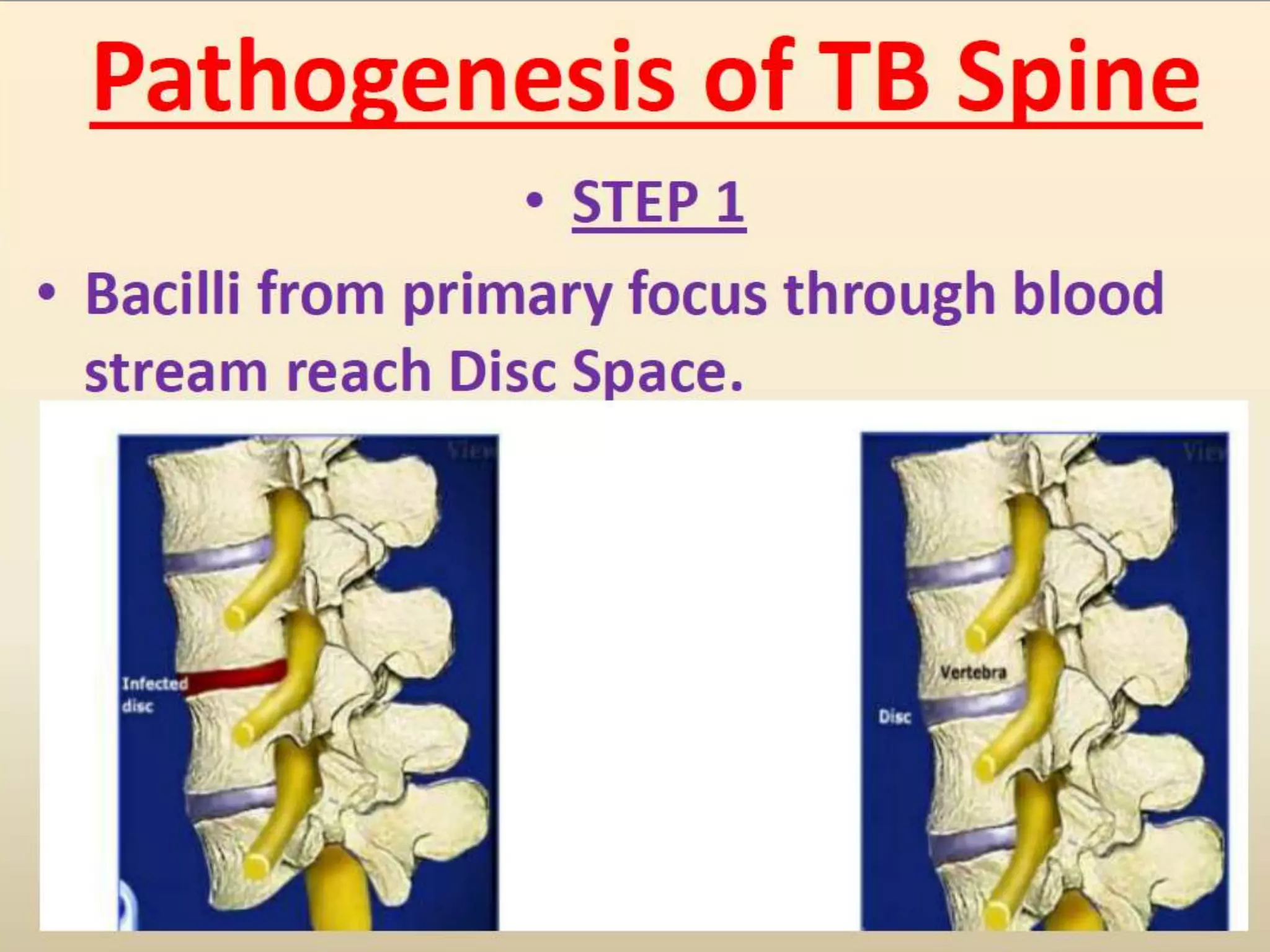 Pott's disease ppt | PPT