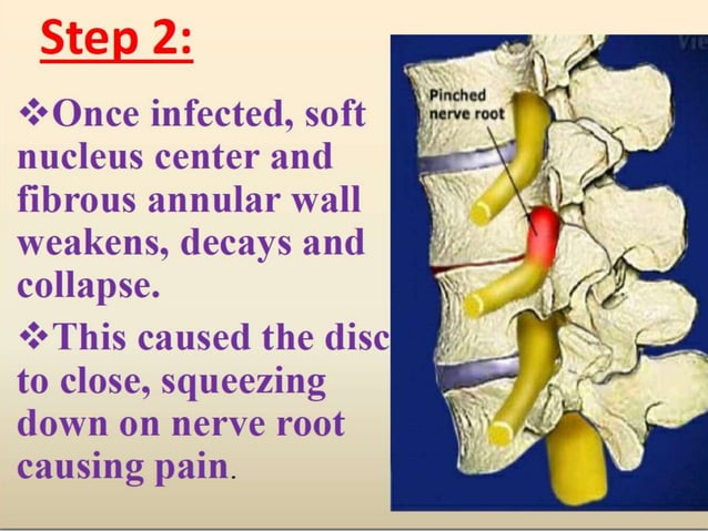 Pott's disease ppt | PPTX | Physical Therapy | Wellness