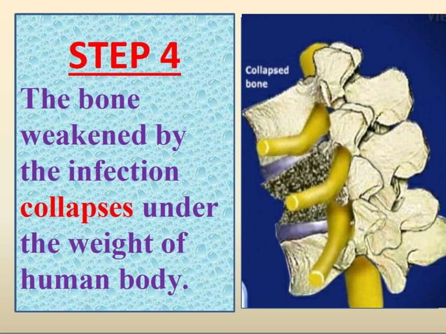 Pott's disease ppt