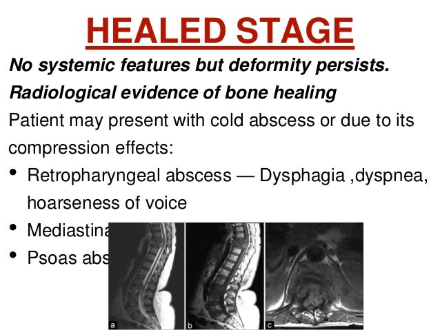 Pott's disease ppt