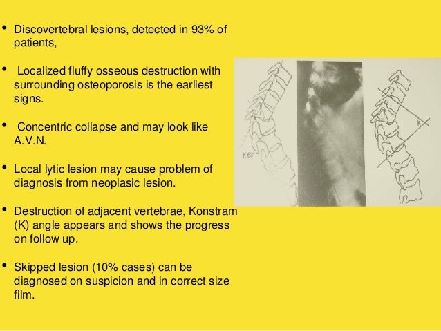 Pott's disease ppt