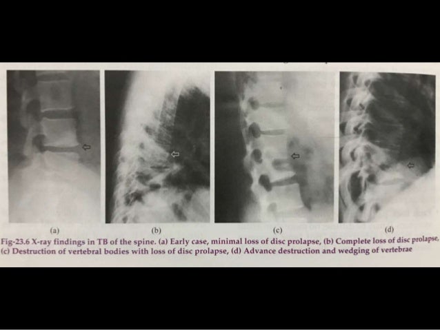 Pott's disease ppt