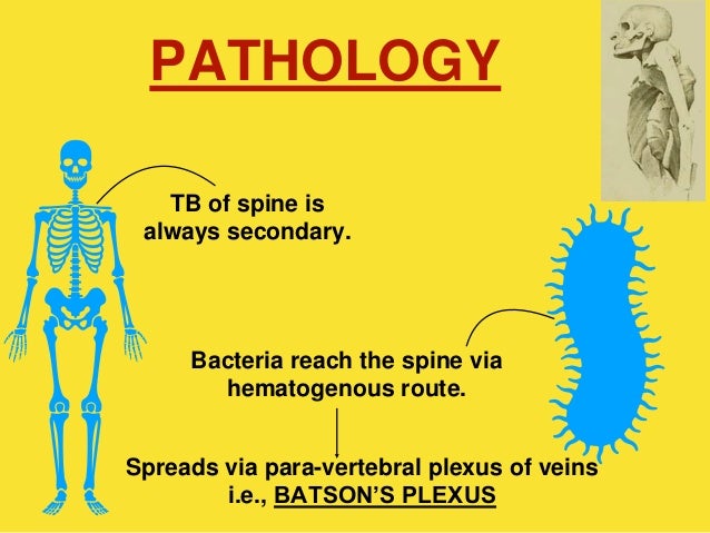 Pott's disease ppt