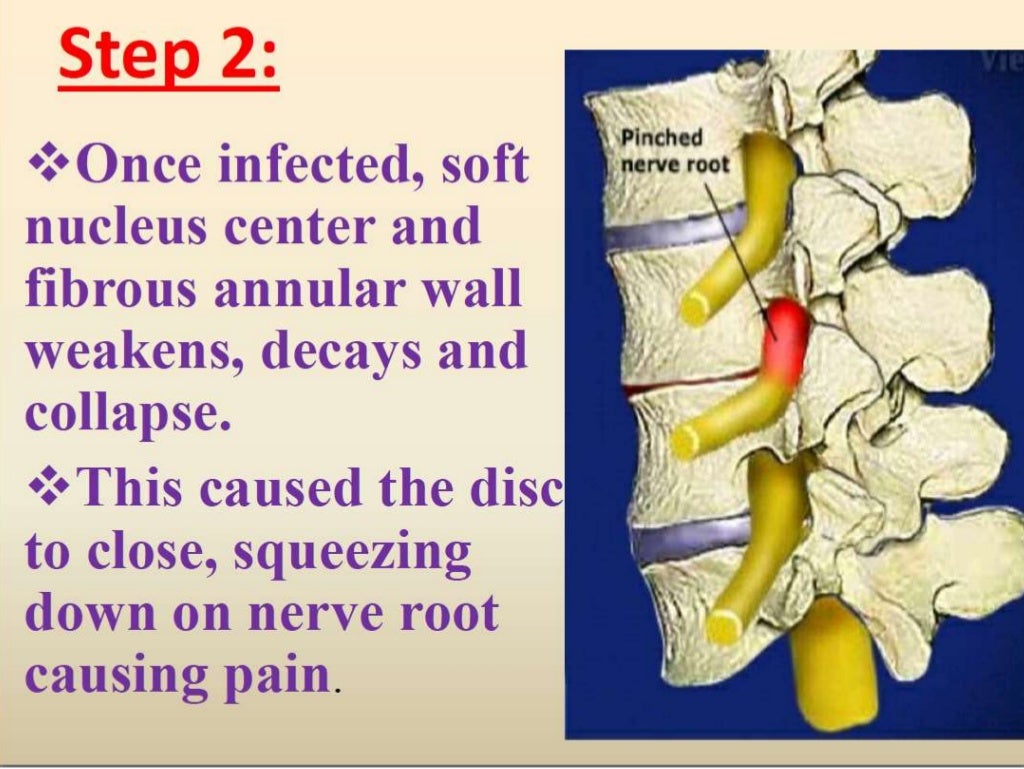 Pott's disease ppt