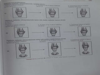 Pottys Fructure Pott’s fracture | PPTX