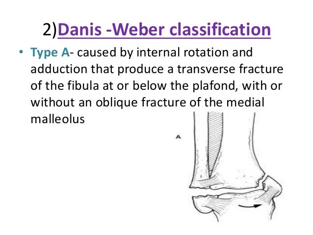 pott s fracture