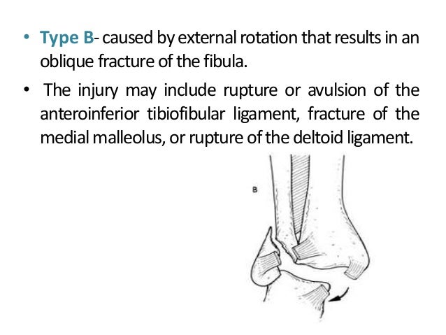 pott s fracture