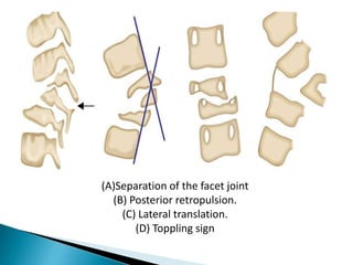 Toppling Sign potts paraplegia and it's consequences in adults | PPTX