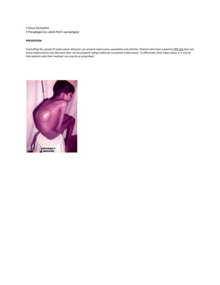 • Sinus formation.
• Paraplegia (so called Pott's paraplegia).
PREVENTION
Controlling the spread of tuberculosis infection can prevent tuberculous spondylitis and arthritis. Patients who have a positive PPD test (but not
active tuberculosis) may decrease their risk by properly taking medicines to prevent tuberculosis. To effectively treat tuberculosis, it is crucial
that patients take their medicati ons exactly as prescribed.

 