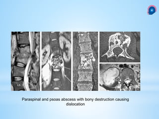 Paraspinal and psoas abscess with bony destruction causing
dislocation
 
