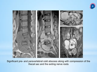 Significant pre- and paravertebral cold abscess along with compression of the
thecal sac and the exiting nerve roots
 