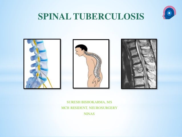 potts spine tb spine