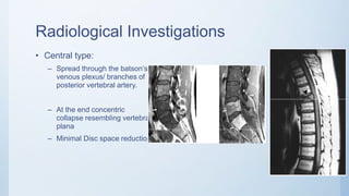 Potts spine | PPTX