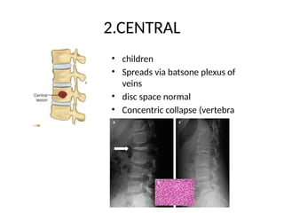 POTTS SPINE.pptx explanation and treatment | PPTX