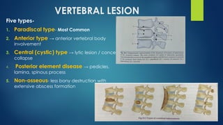 Comprehensive Overview of Pott's Spine: Diagnosis and Management ...