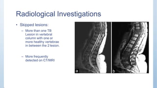 Radiological Investigations
• Skipped lesions:
– More than one TB
Lesion in vertebral
column with one or
more healthy vertebrae
in between the 2 lesion.
– More frequently
detected on CT/MRI
 